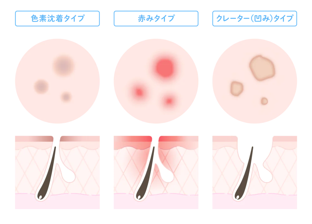 ニキビ跡